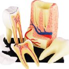 Triple root Molar Model